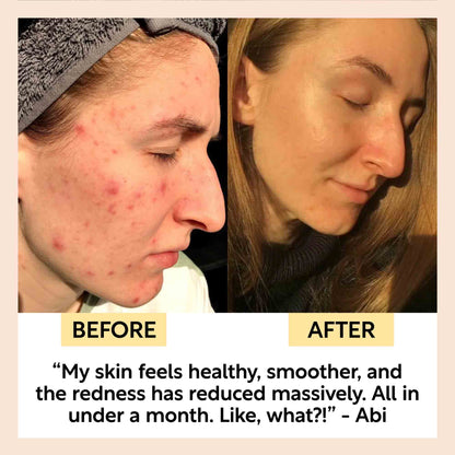 The Acne-Prone Bundle