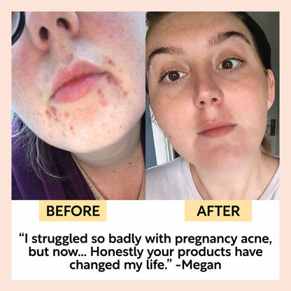 The Acne-Prone Bundle