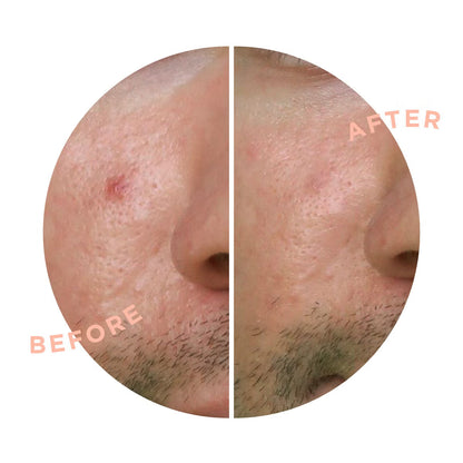 ZITSTICKA Spot Clarifying Patch Kit